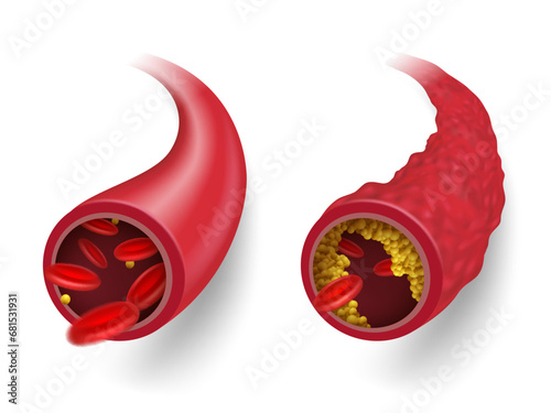 Compare normal blood flow With blood vessels that have accumulated cholesterol, causing fat clogs and abnormal blood flow. Causing the blood vessels to swell. Medical and health concepts. EPS file.