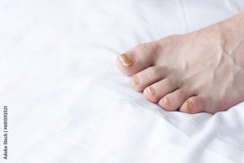 Male cut nails with nail fungus. Fungal infection on hands legs, finger with onychomycosis. Care and treatment. Closeup of a foot with damaged nails because of fungus Male cut nails with nail fungus. Fungal infection on hands legs, finger with onychomycosis. Care and treatment. Closeup of a foot with damaged nails because of fungus