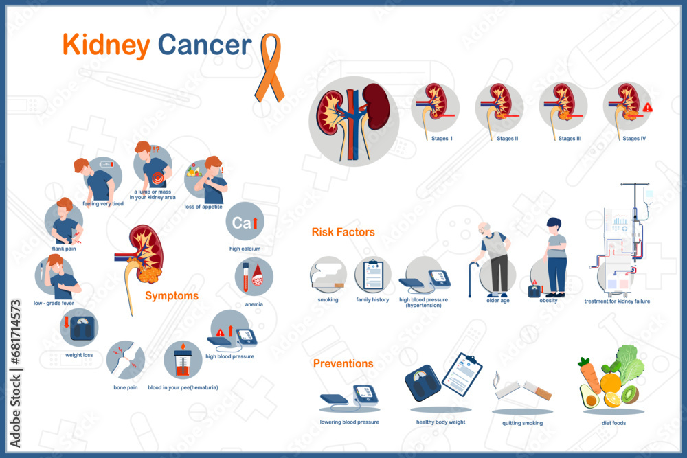 Flat Medical Vector Illustration Infographic Kidney Cancer Concept Flat Medical Vector Illustration Infographic Kidney Cancer Concept