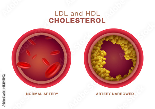 Types of comparison of atherosclerotic cholesterol with HDL and LDL lipoproteins. Cross section of normal and narrow arteries with clogged arteries. can cause high triglycerides. Vector illustration.