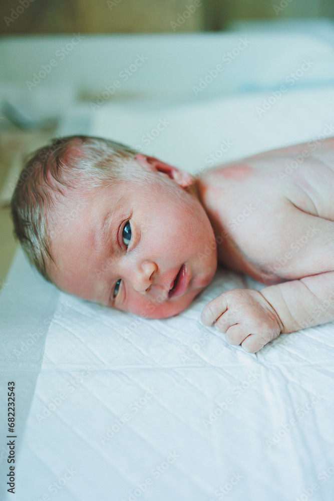A newborn baby is lying on a diaper with a red rash on his body