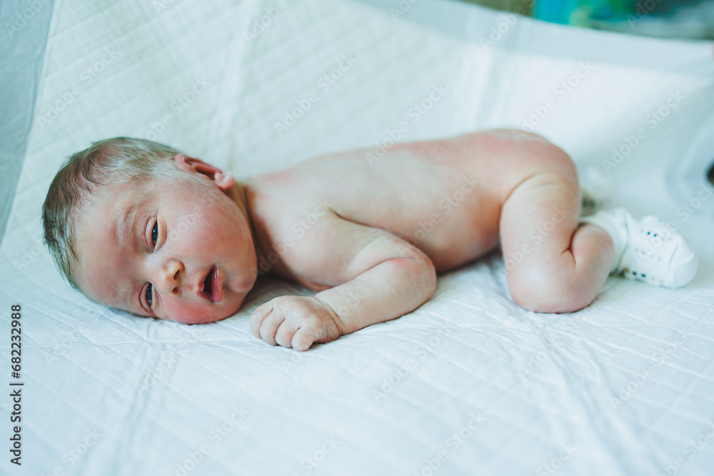 A newborn baby is lying on a diaper with a red rash on his body