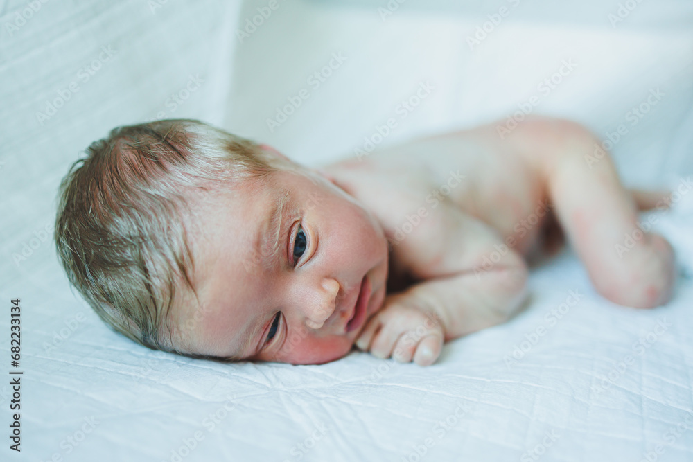 Foto de A newborn baby is lying on a diaper with a red rash on his body
