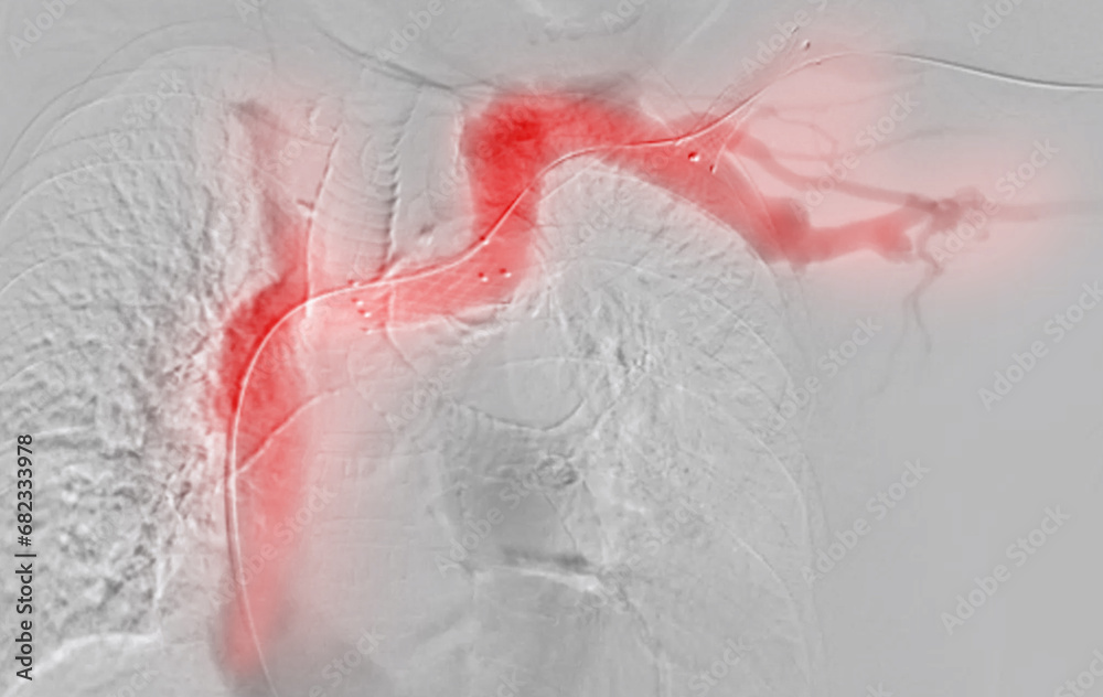 Balloon Angioplasty is a medical procedure used to widen narrowed or ...