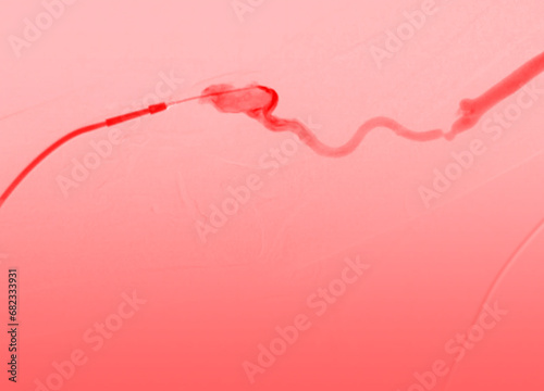 Balloon Angioplasty is a medical procedure used to widen narrowed or blocked blood vessels.