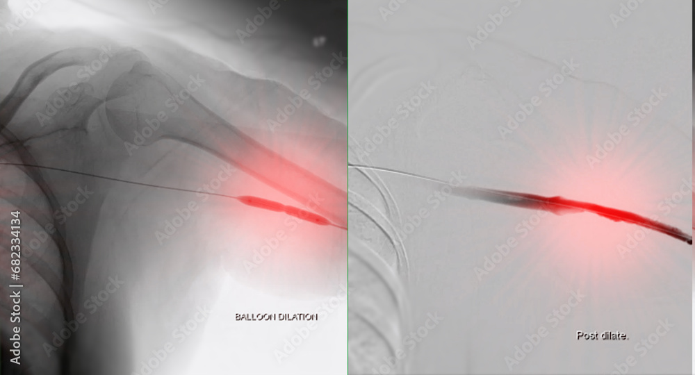 Balloon Angioplasty is a medical procedure used to widen narrowed or ...