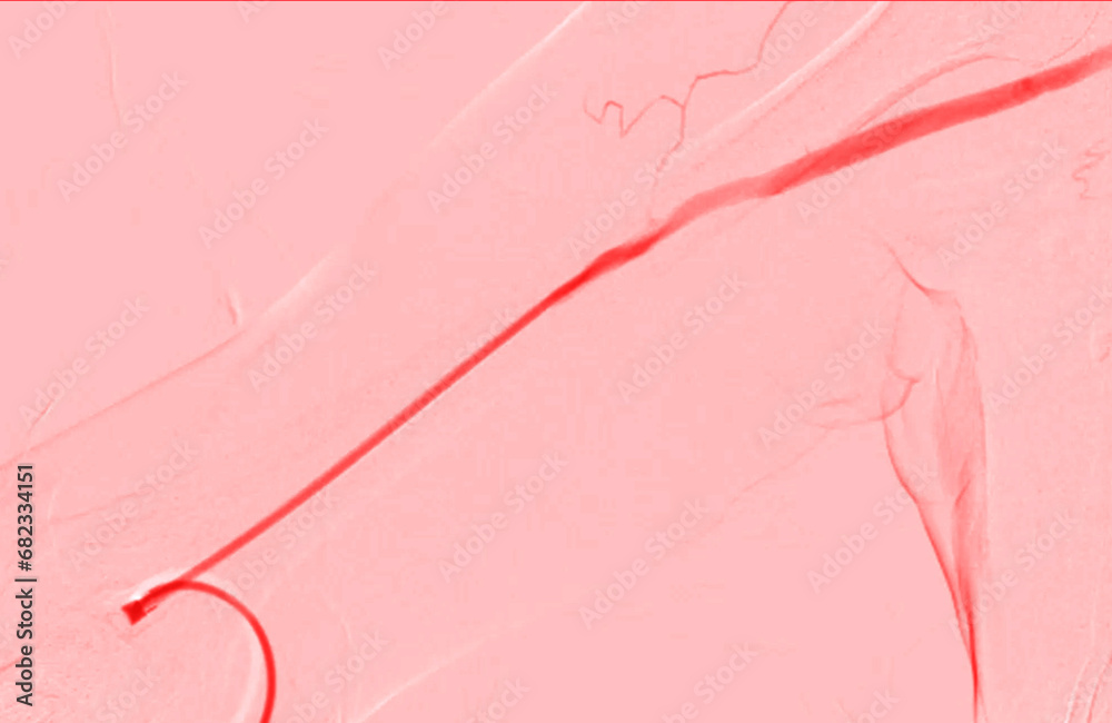 Balloon Angioplasty is a medical procedure used to widen narrowed or ...