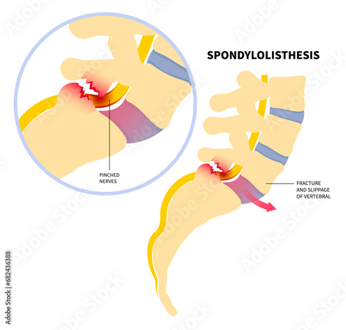 The Spondylolisthesis a spinal disease that causes one of lower vertebrae slip forward with hip bone disk pain in sports accident injury and epidural steroid injections to nerve for fusion leg