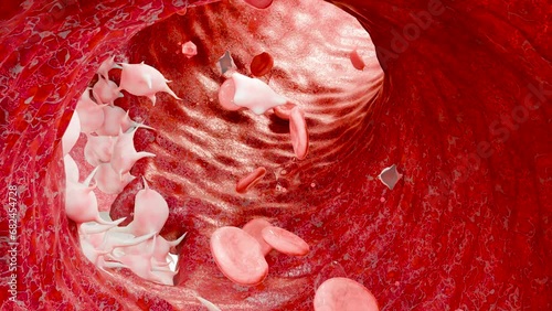 Hemostasis. Red blood cells and platelets in the blood vessel, vasoconstriction, wound healing process. hemorrhage clot embolisms, Hemophilia. fibrinolysis, injury bleeding coagulation, 3d render photo