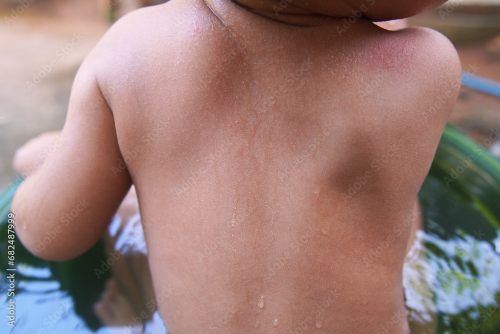 Toddler was bathing, his upper back was bitten by an insect. reddish color to the skin. mosquito bite marks Toddler was bathing, his upper back was bitten by an insect. reddish color to the skin. mosquito bite marks