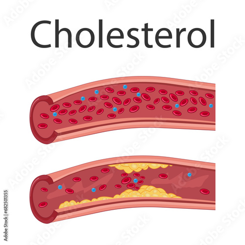 Atherosclerosis concept. enlarged artery with plaques. Medical vector illustration