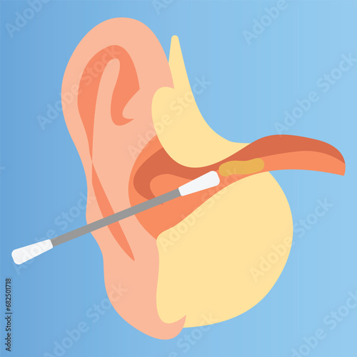 Cleaning a human ear with a cotton swab