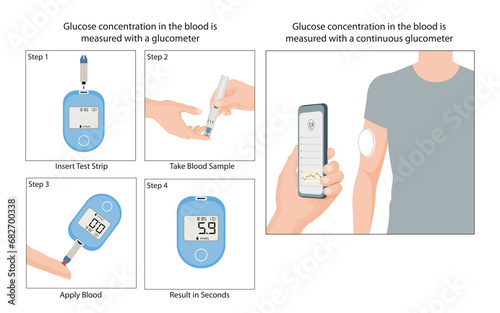 Glucometer for Blood Sugar Monitoring