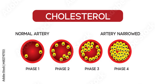 Cholesterol in artery, health risk , HDL and LDL in artery, Cholestane test
