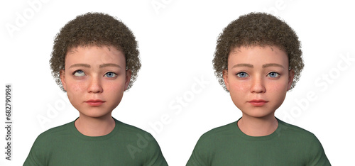 A child with hypertropia and a healthy man, 3D illustration