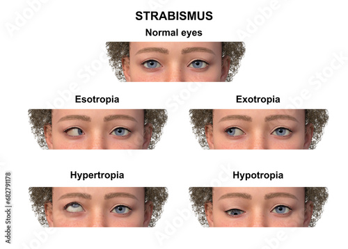 Фотография A child with various strabismus types, 3D illustration