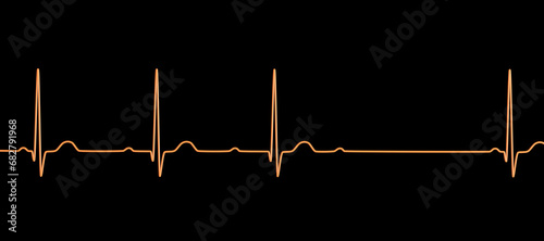 An ECG with 2nd degree AV block, 3D illustration photo