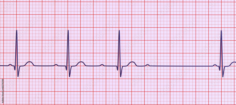 An ECG with 2nd degree AV block, 3D illustration An ECG with 2nd degree AV block, 3D illustration