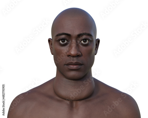 A man with enlarged thyroid gland, 3D illustration photo