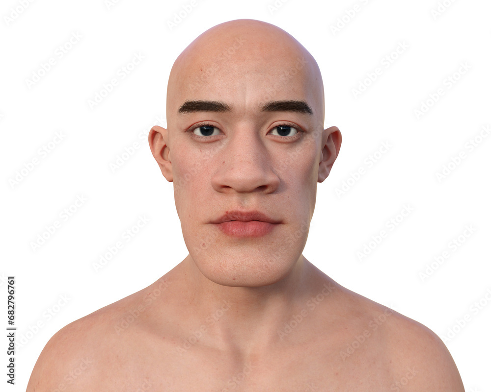 Fototapeta premium Acromegaly in a man, 3D illustration