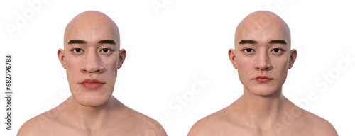 Acromegaly in a man, and the same healthy man, 3D illustration