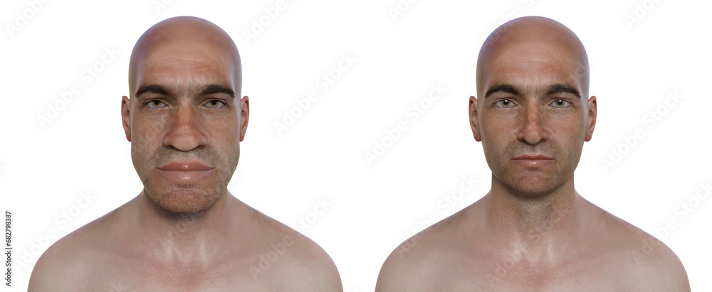 Acromegaly in a man, and the same healthy man, 3D illustration Acromegaly in a man, and the same healthy man, 3D illustration