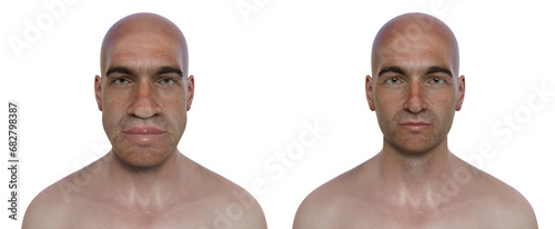 Acromegaly in a man, and the same healthy man, 3D illustration photo
