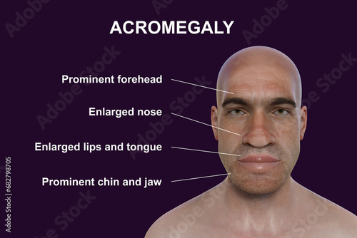 Acromegaly in a man, and the same healthy man, 3D illustration