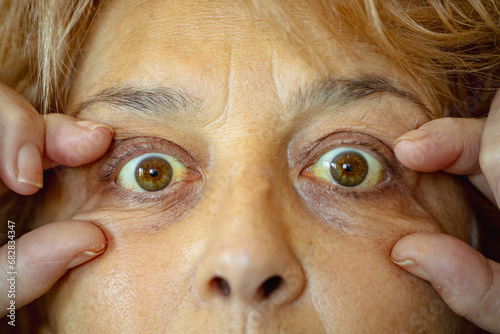 cancer patient. shot of the yellowish eyes. severe form of hepatitis. medical concept. life and health. photo