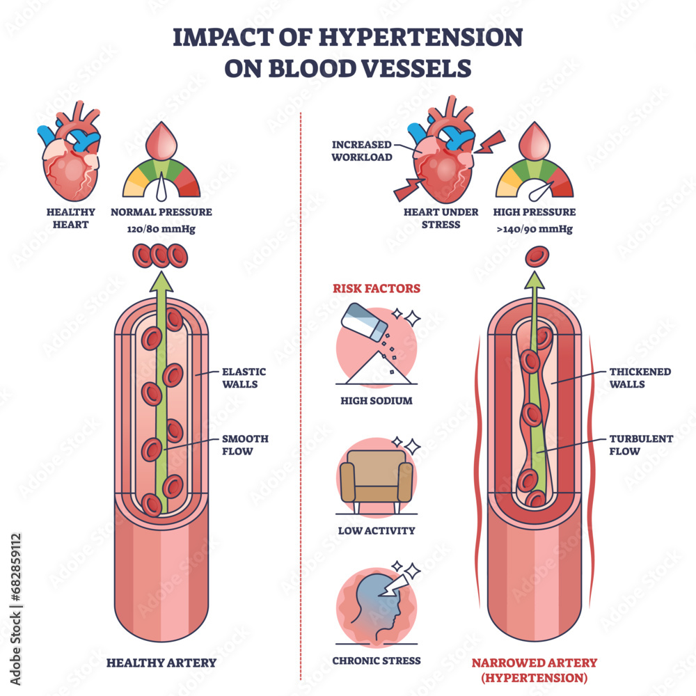 Impact of hypertension on blood vessels with high pressure outline diagram. Labeled educational scheme with healthy vs narrowed artery and turbulent flow vector illustration. Medical risk factors. - obrazy, fototapety, plakaty 