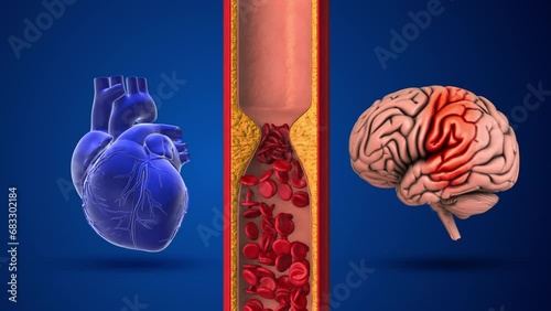 Difference between stroke and heart attack photo