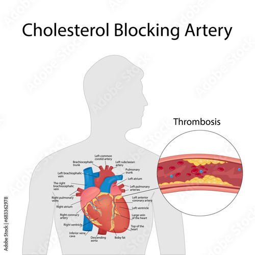 Atherosclerosis concept, health risk. Human heart. Medical vector illustration