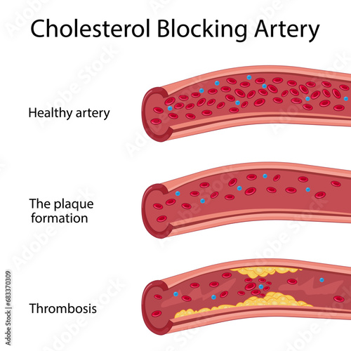 Healthy and narrowed blood vessels with accumulation of cholesterol plaques. The artery is blocked by a clot of fat cells. Comparison of LDL and HDL lipoproteins. Medical cross-section diagram. Vector