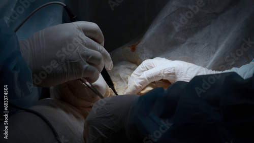 Cardiac surgeon and team perform median sternotomy. Action. Surgeon cauterizing and using professional tool. photo