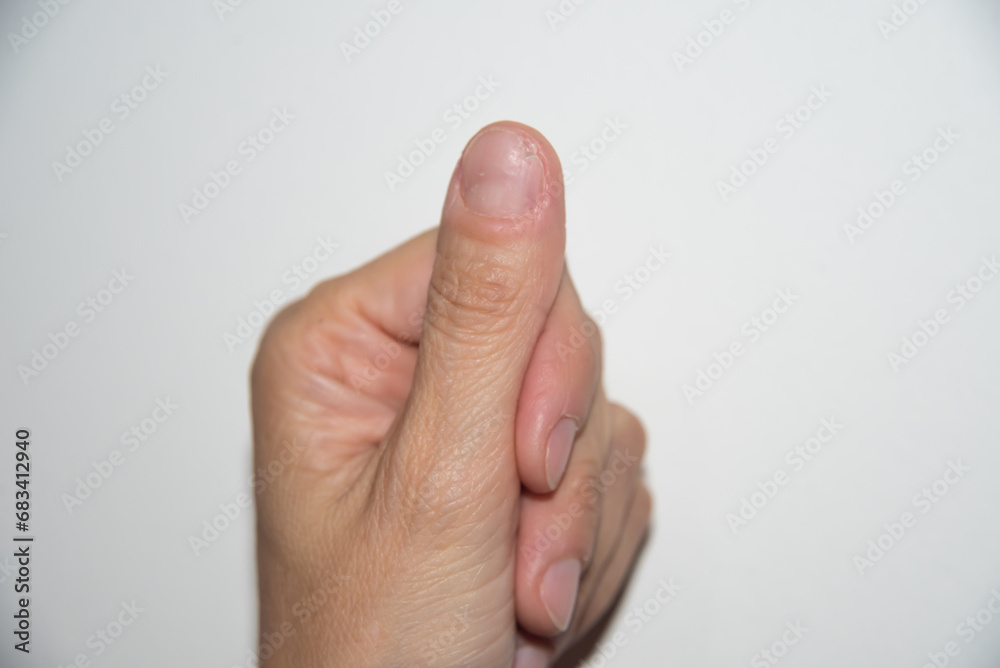fingernail, dead root nail, onychogaphy, dermatology, fingernail fingernail, dead root nail, onychogaphy, dermatology, fingernail