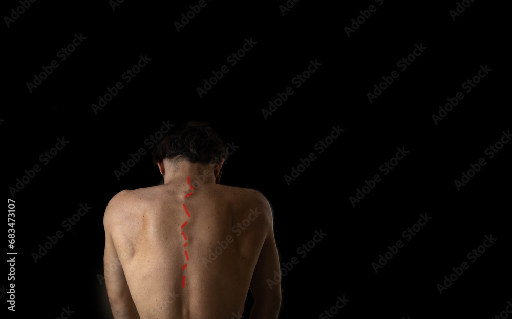 back of a man with a curved spine, scoliosis on a dark background ...
