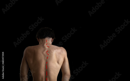 back of a man with a curved spine, scoliosis on a dark background.