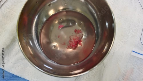The appearance of herniated lumbar discs in a surgical bowl of water after herniated disc surgery photo