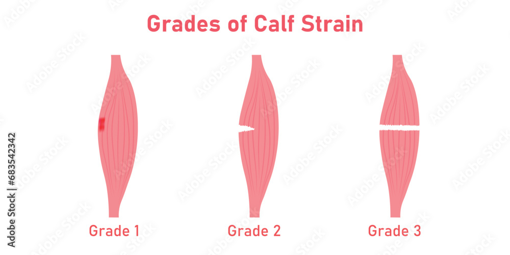 Three grades of calf strain diagram. Gastrocnemius strain. Scientific