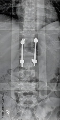 X-ray image showing lumbar spine fracture fixation