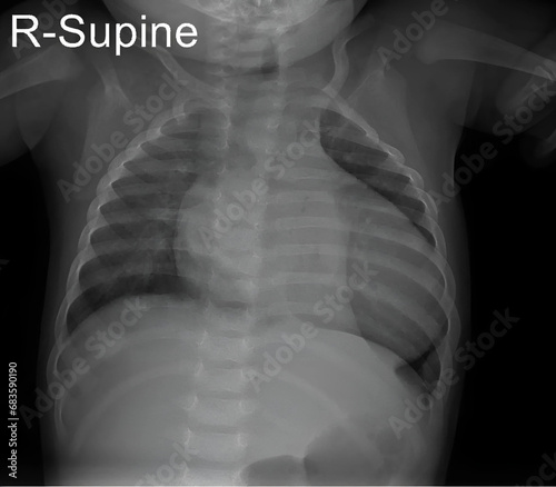 Pediatric chest X-ray revealing the thoracic anatomy of a child