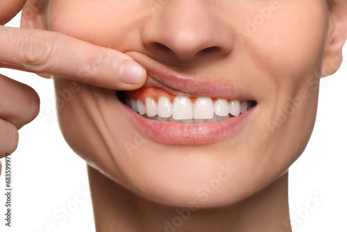 Woman showing inflamed gum on white background  closeup