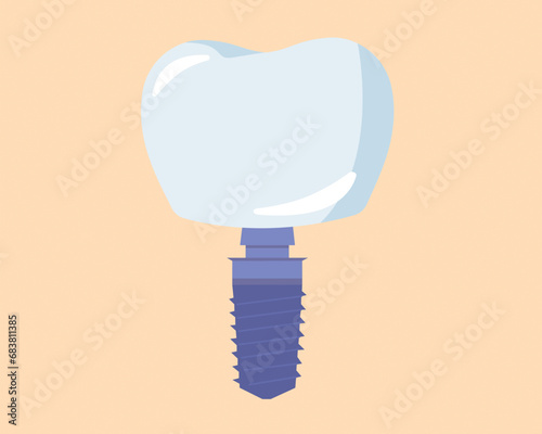 Dental implant teeth healthcare dentist and orthodontist treatment