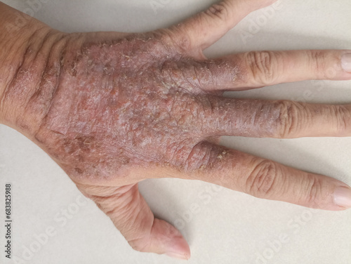 rash eczema dermatitis  on hand. inflammation of skin