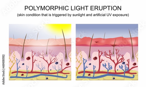 Polymorphic light eruption Illustration photo