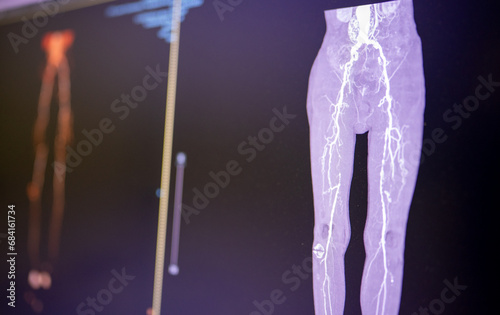 CT image of chronic arterial occlusion in Superficial femoral -popliteal artery segment. Fem-pop occlusion.  photo