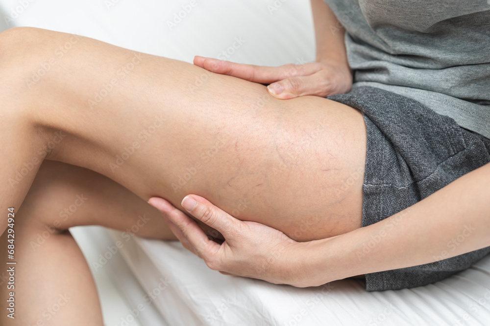 Health care beauty, varicose veins on skin of leg, woman hand showing vascular, thrombosis on legs on bed room at home. Vascular disease, varicose vein problem. Treatment with medicine and cosmetology Health care beauty, varicose veins on skin of leg, woman hand showing vascular, thrombosis on legs on bed room at home. Vascular disease, varicose vein problem. Treatment with medicine and cosmetology