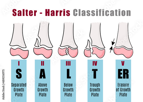 Salter - Harris classification to to recognize and identify different types of bone fractures