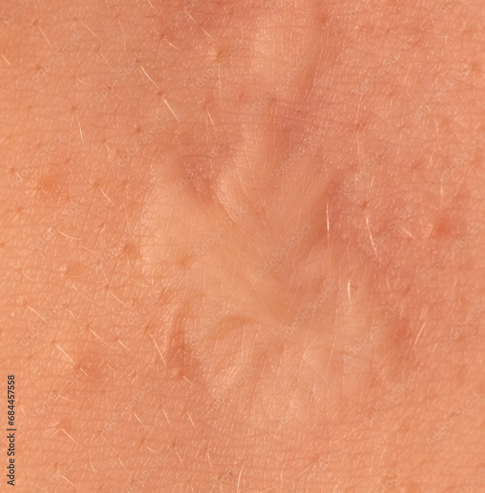 Fototapeta premium Scar on human skin after heart surgery