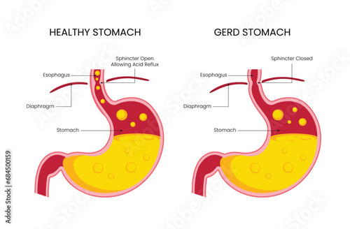 Vector Diagram of Healthy Stomach and Gerd Disease